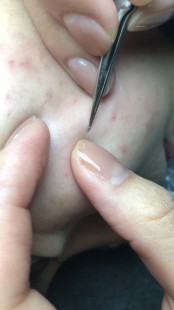 丁丁长痘痘,上长了好多痘痘