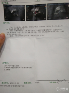 宫内早孕盆腔积液,宫内早孕盆腔积液是怎么回事