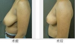 997221,乳腺结节手术后多久能完全恢复