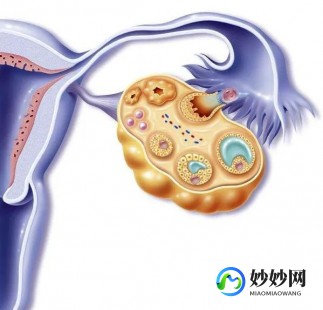 amh高,amh升高了是怎么回事？多囊卵巢综合征是主要原因