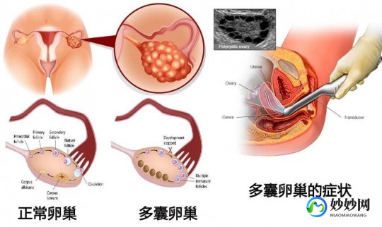 amh高,amh升高了是怎么回事？多囊卵巢综合征是主要原因