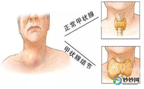 甲状腺3类结节严重吗,甲状腺3类结节严重吗
