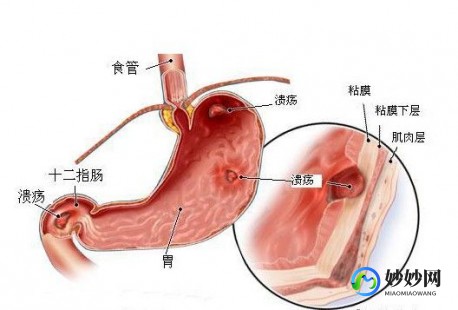 上消化道,什么叫上消化道溃疡