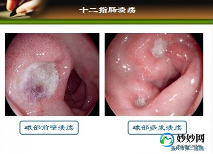 上消化道,什么叫上消化道溃疡