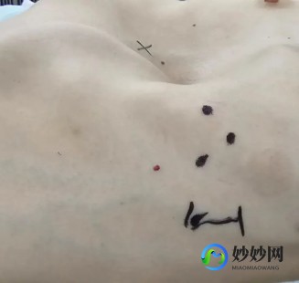 漏斗胸的危害,漏斗胸对人体的危害性
