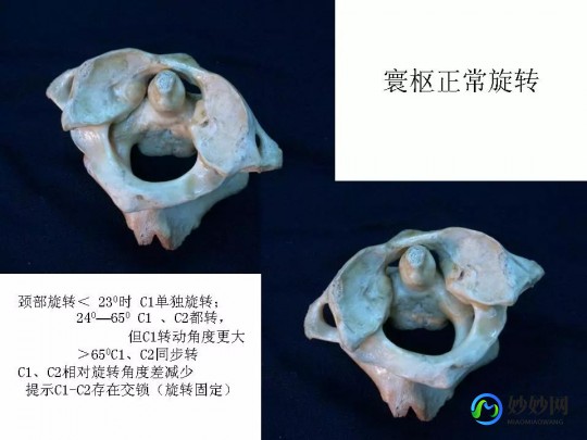 寰枢关节脱位,寰枢椎脱位全解读