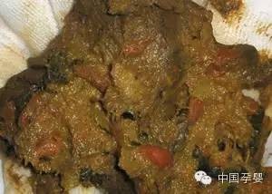 屎有白色的粘稠物,大便带白色粘液