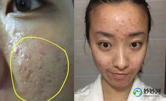 去痘痘疤,长过痘痘留下的疤怎么去掉