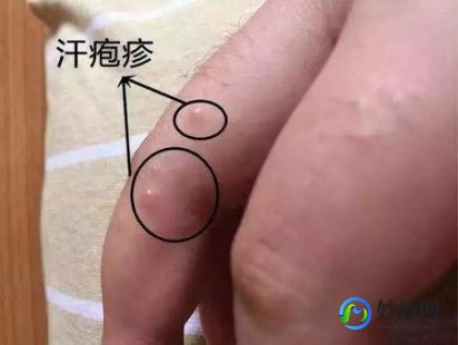 治疗汗疱疹最好的药膏,汗疱疹最佳药膏