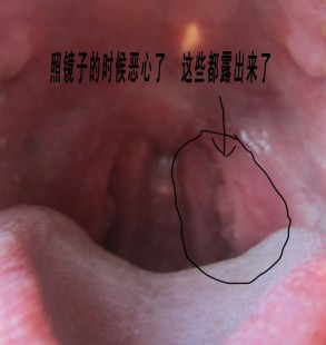 喉咙有异物感吞咽有堵塞感,喉咙里面感觉有异物堵怎么办