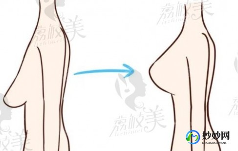 丰胸针,丰胸针安全吗