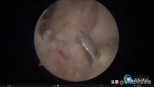 交叉韧带,什么是膝关节交叉韧带