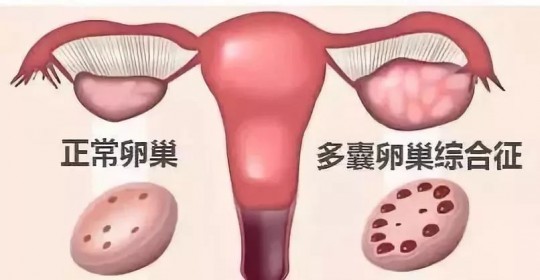 盆腔瘀血综合征,盆腔瘀血综合征有哪些表现