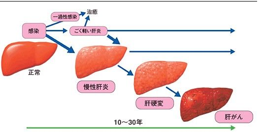 黄疸型乙型肝炎,黄疸性肝炎是乙肝吗