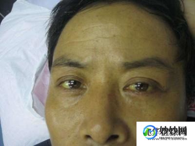 黄疸型乙型肝炎,黄疸性肝炎是乙肝吗