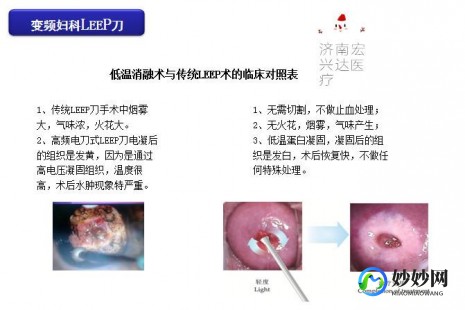leep刀手术后,做了利普刀多久恢复