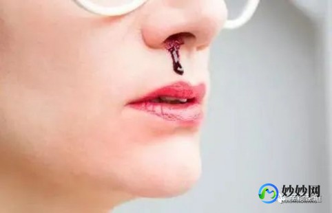 出鼻血,流鼻血怎么治疗