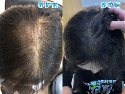 女生脱发,女性头发老是掉该怎么办