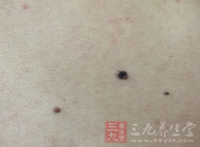 如何点痦子,痦子怎么去掉