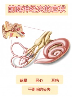前庭神经元炎,前庭神经元炎严重吗