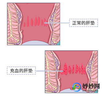 为什么会得肛瘘,导致肛瘘的原因