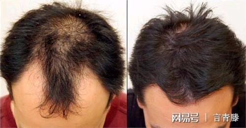 头发稀少如何加密,头发稀少如何加密