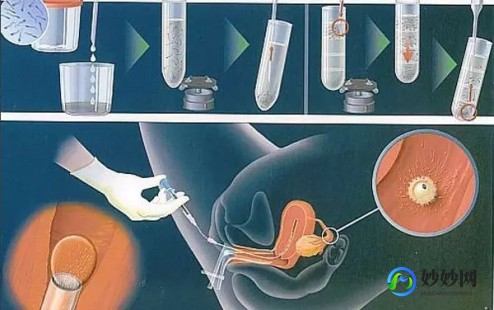 子宫灌精,宫腔人工授精的植入精子的步骤是怎么样的？