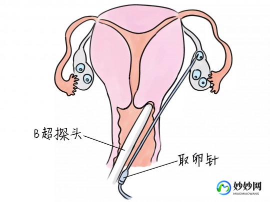 女性左侧小腹靠近胯骨处疼,左下腹靠近胯骨处隐痛的原因