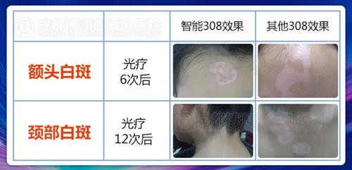 308准分子激光,什么是308nm准分子激光光疗