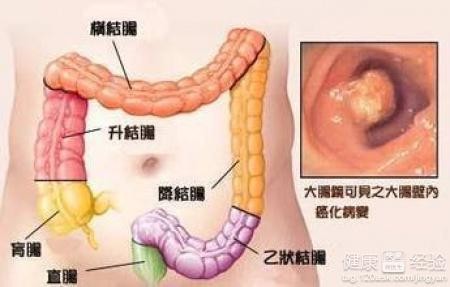 直肠癌晚期治疗,直肠癌晚期的治疗方法是什么