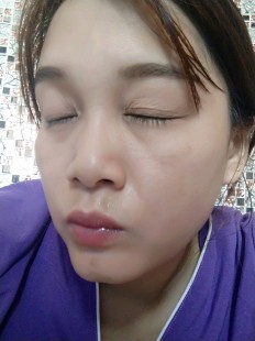 眼皮子薄,眼皮太薄怎么办