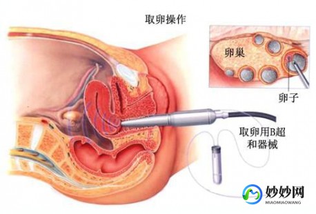 取卵针,取卵针一次可以吸多少个卵