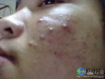 如何治疗脸部痤疮,脸上的痤疮怎么治疗