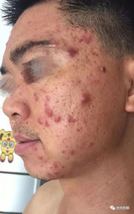 如何治疗脸部痤疮,脸上的痤疮怎么治疗