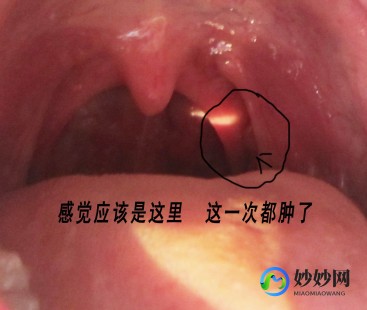 喉咙有异物感,嗓子感觉像卡了个东西的感觉