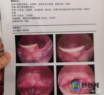 喉咙有异物感,嗓子感觉像卡了个东西的感觉