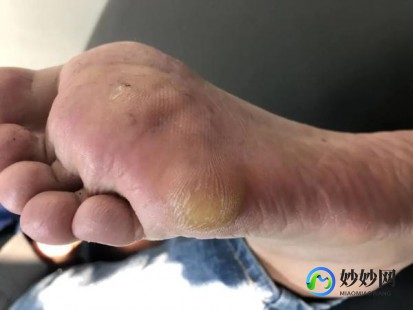 鸡眼是怎么形成的,鸡眼是怎么形成的