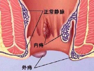 女性痔疮治疗方法,女性痔疮怎么治疗