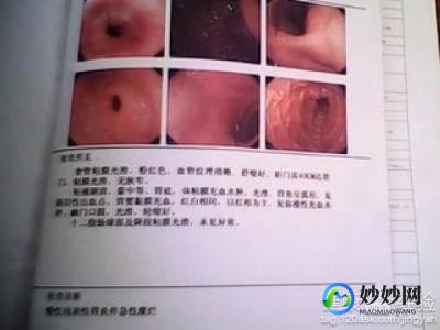 慢性浅表性胃窦炎,慢性浅表性胃窦炎严重吗