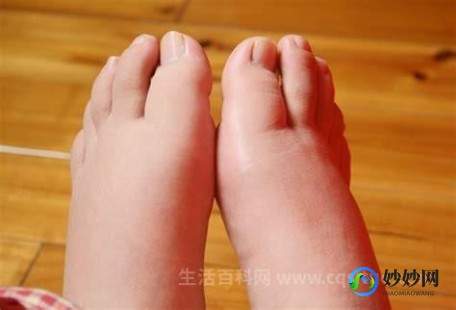 脚肿是什么病的前兆,脚肿是什么病的前兆