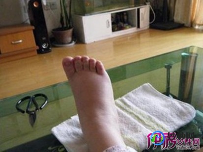 脚肿是什么病的前兆,脚肿是什么病的前兆