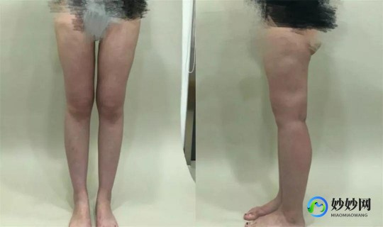 臀部吸脂,了解什么是臀部吸脂