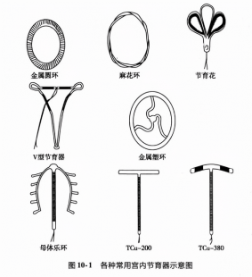 宫内节育器,节育环的形状图片有几种