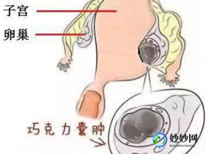 巧囊吃药可以消除吗,巧囊吃药可以消除吗