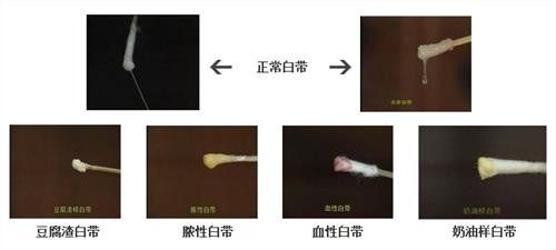 正常白带的颜色,白带什么颜色正常