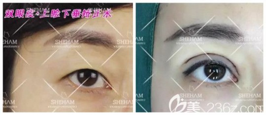 内眦赘皮,内眦赘皮如何改善？