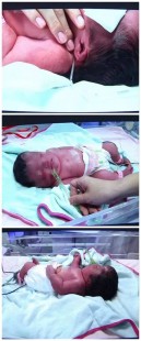 硫酸镁保胎,硫酸镁保胎对胎儿影响