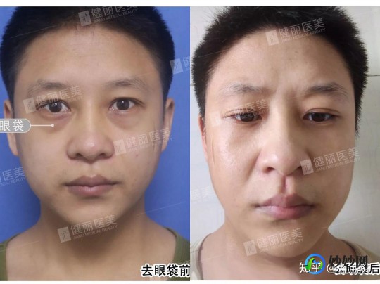 打针去眼袋,打针去眼袋能保持多久