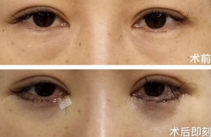 打针去眼袋,打针去眼袋能保持多久