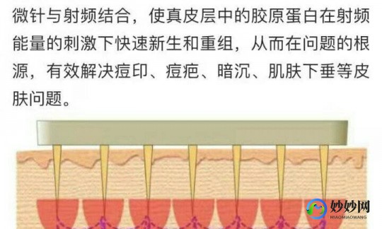 黄金微针多少钱,黄金微针一个疗程多少钱